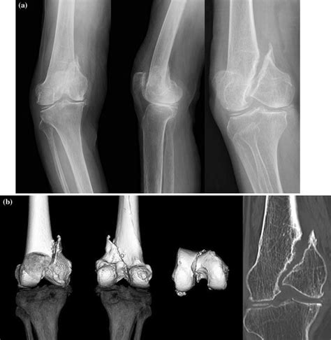 Radiographs Demonstrating Medial Condyle Fracture Nonunion Of The