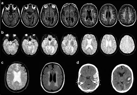 Primary Progressive Aphasia And Cerebral Amyloid Angiopathy A Flair