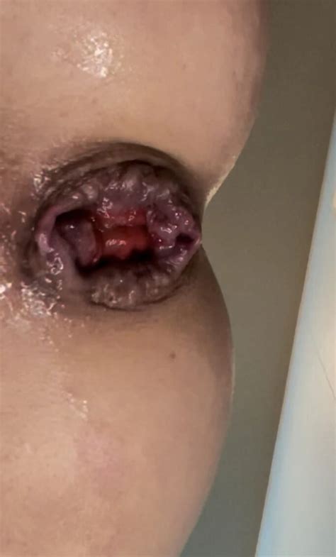 StaceyLovesAnal Stretched Hole Nude Pics XHamster