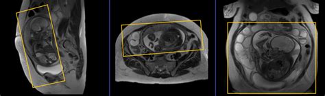 Fetal abdominal MRI | Fetal abdominal MRI protocol and planning