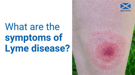 Lyme Disease Symptoms