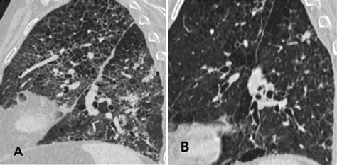 Sagittal Reconstruction Of Chest Hrct Before A And After B The