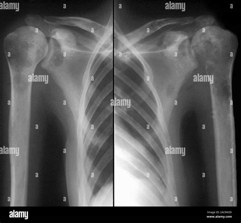 Secondary bone cancer. X-ray of the shoulders of a 39 year old patient with metastatic ...