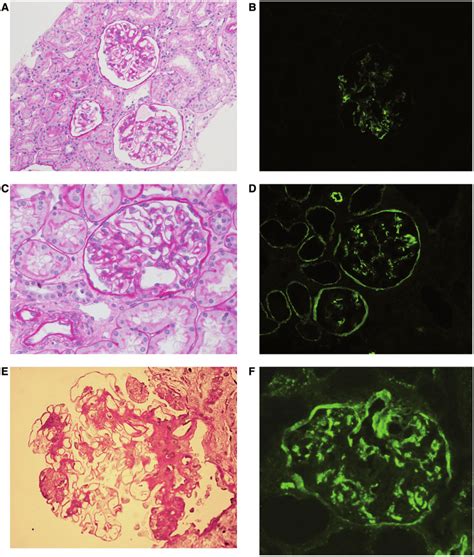 Renal Biopsy Findings In The Three Paediatric Patients With Huvs