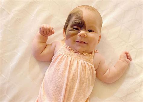 Meet Little Winry The Baby Born With A Unique Birthmark Newspapers