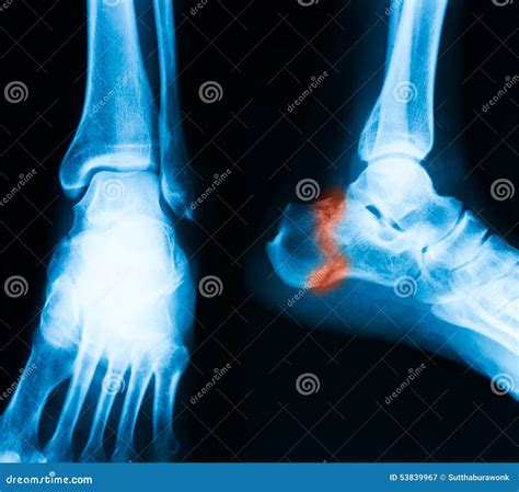 X Ray Image Of Broken Calcaneus Ap And Lateral View Stock Image