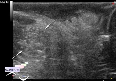 Testicular Microlithiasis Microcalcification Scrotum Sonography