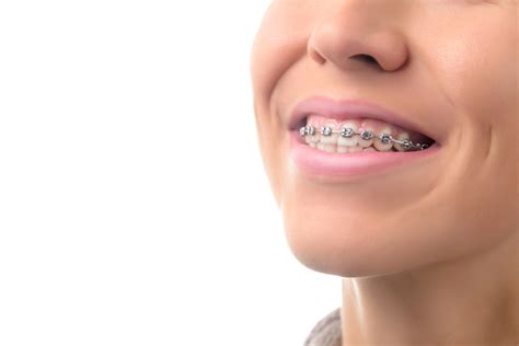 5 Signs You May Need Braces - Belmar Orthodontics