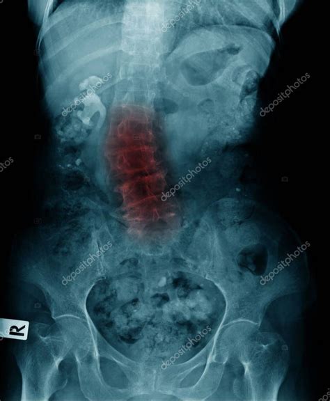 Lumbar Spondylosis Scoliosis Ray Image Lateral View - Stock Photo , #AFF, #Scoliosis, #Ray, # ...