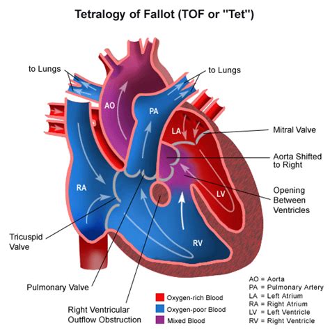 Tetralogy Of Fallot Pathophysiology Wikidoc