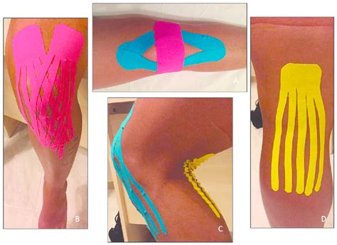 Kinesio Tape Application A With Tension Stabilizing Effect 2