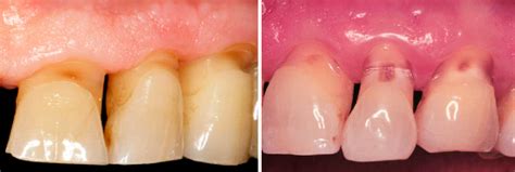 ¿qué Es Y Cómo Se Puede Solucionar La Abrasión Dental