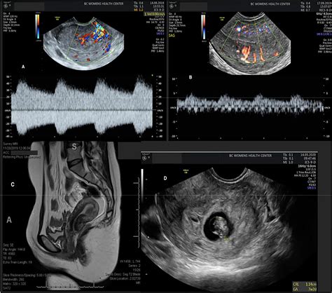 Medical Management Of Uterine Arteriovenous Malformation A Case Series