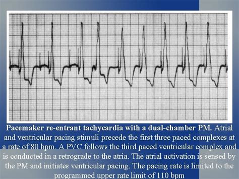 Pacemaker Malfunction Ecg Signs Of Pacemaker Malfunction Failure