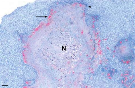 Liver Abscess Histology