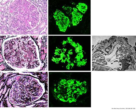 Membranoproliferative Glomerulonephritis Immunofluorescence