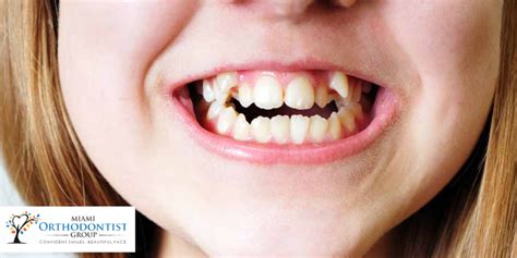 Different Types Of Bite Alignment And Treatment Miami Orthodontist Group