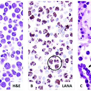 Primary Effusion Lymphoma Pel In Individuals Infected By Hiv A In