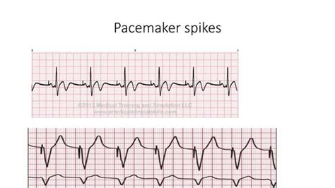 Pacemaker | PPT