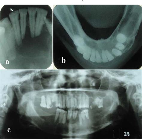 Figure From Unicystic Ameloblastoma Presenting As A Multilocular