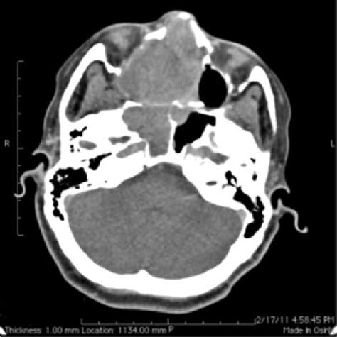 Contrast-enhanced CT scan of the nasal cavity and paranasal sinuses ...