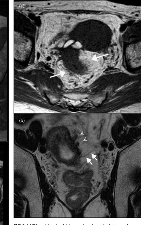 Figure From Effect Of Endorectal Coils On Staging Of Rectal Cancers