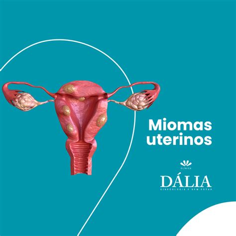 Miomas Uterinos Saiba Tudo Sobre Estes Tumores Mioma Uterino