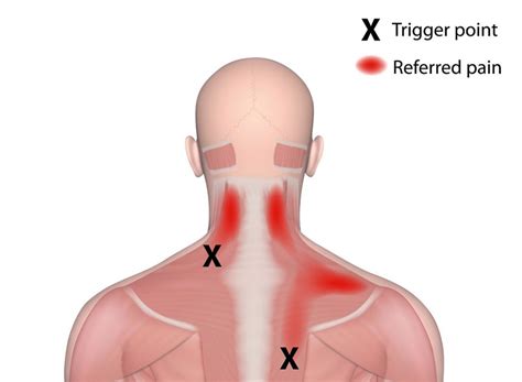 Myofascial Pain Syndrome Diagnosis And Treatment