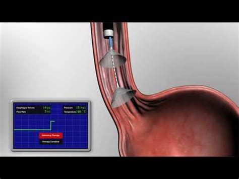 Aqua Circumferential Ablation Catheter - YouTube