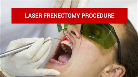 Laser Frenectomy Procedure Before And After Dental Solutions Youtube