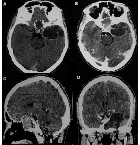 A D Cect Brain And Paranasal Sinuses Showing Infiltrative