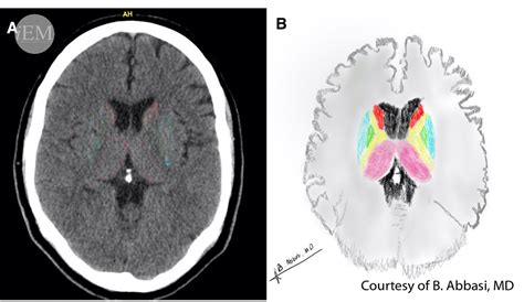 Figure Axial Brain Ct Scan Figure Axial Br Flickr