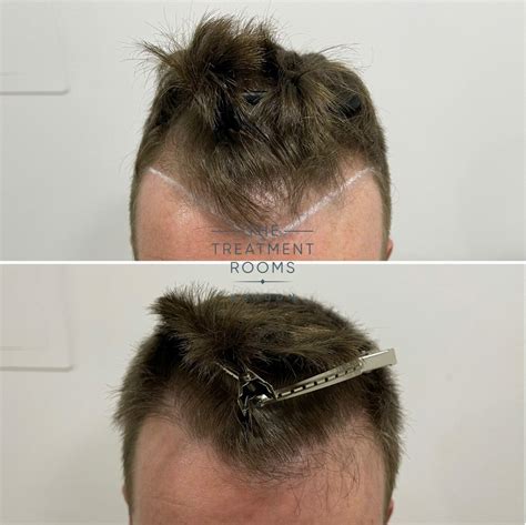 Fue Hair Transplant 1073 Grafts Treatment Rooms London