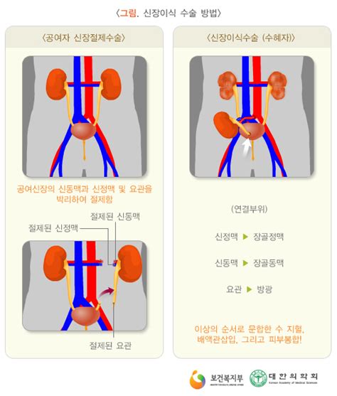 신장이식절차 부작용 네이버 블로그