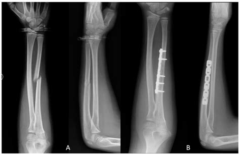 Ulna Fracture X Ray