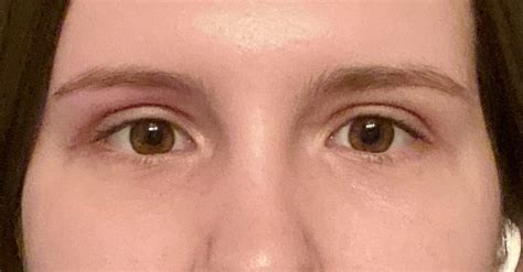 11 Upper Eyelid Surgery Before And After Photos Dallas Plano Texas Cosmetic Reconstructive