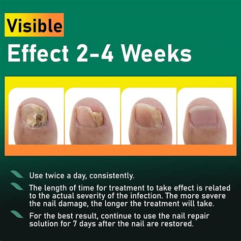 XIFEPFR Toenail Repair Treatment - Extra Strength Nail Renewal Solution
