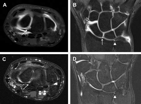 Imaging Of The Hand And Wrist Clinics In Sports Medicine