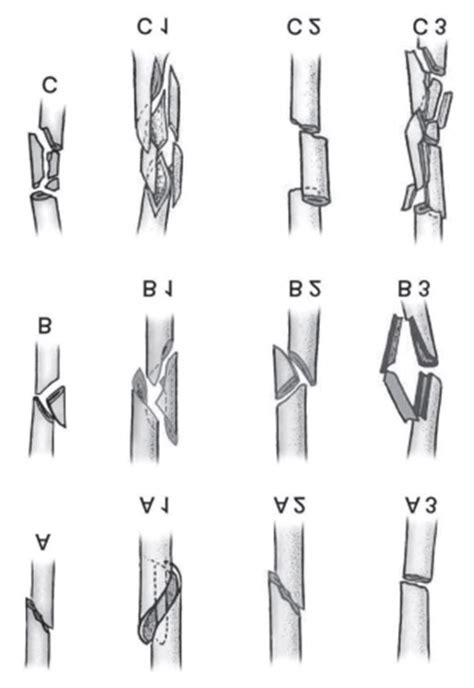 Ao Classification Distal Third Diaphyseal Fractures Of The Humerus Hot Sex Picture