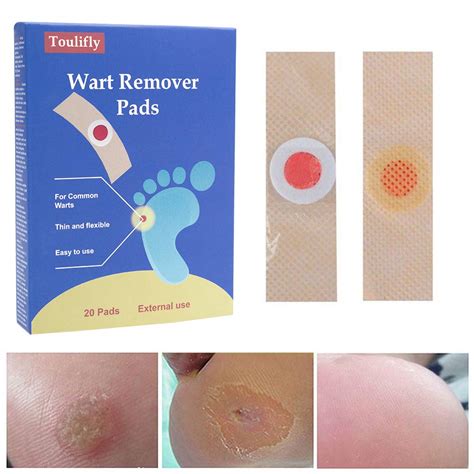 Wart Remover Corn Remover Foot Corn Remover Pads Plantar Wart Removal