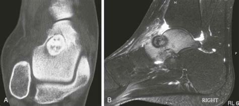 Primary Bone Tumors Clinical Tree