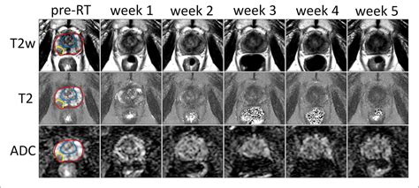 Figure From Quantitative Mri Changes During Weekly Ultra