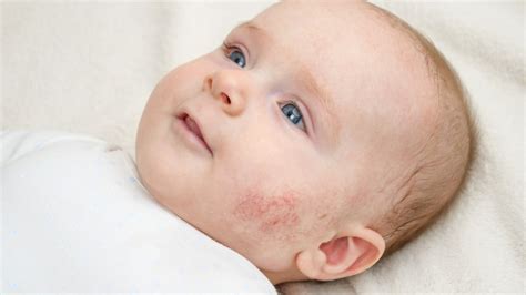 ATOPIC DERMATITIS IN CHILDREN