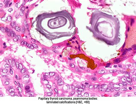 Pathology Outlines - Calcification