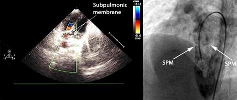 A Transthoracic Echocardiogram In A Subcostal View Showing A Discrete