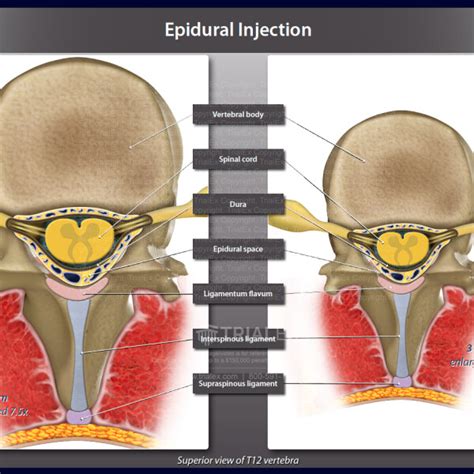 Epidural Injection - TrialExhibits Inc.