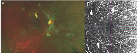 OCT-A in macular disorders: tips, tricks and practical clinical use - Insight