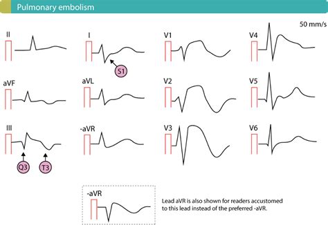 Pin on EKG Stuffs