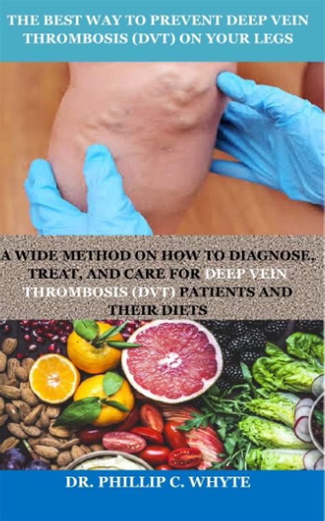 Buy The Best Way To Prevent Deep Vein Thrombosis Dvt On Your Legs A Wide Method On How To