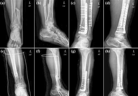 Distal Tibia Fracture